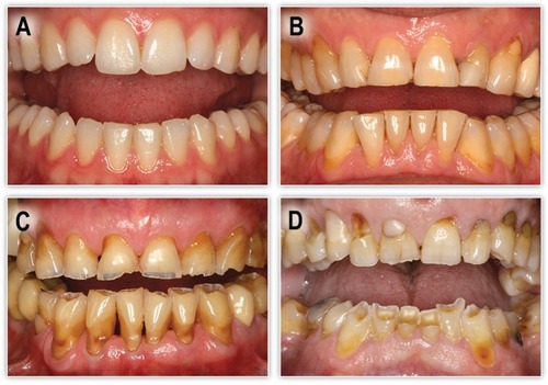 Frequency of Obstructive Sleep Apnea Syndrome in Dental Patients with Tooth Wear